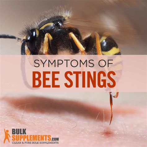 Bee Sting Pictures What Does A Bee Sting Look Like Bee Sting Pictures What Does A Bee Sting Look Like
