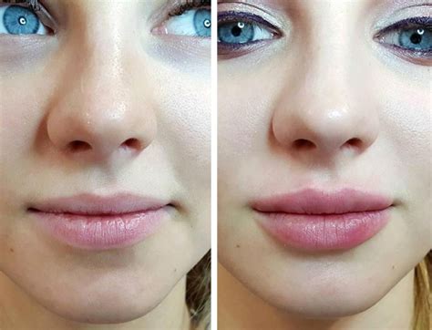 Cheap Lip Injections Near Me