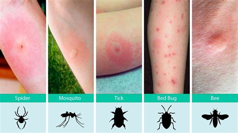 Types Of Insect Bites Uk At Richard Lowery Blog Types Of Insect Bites Uk At Richard Lowery Blog